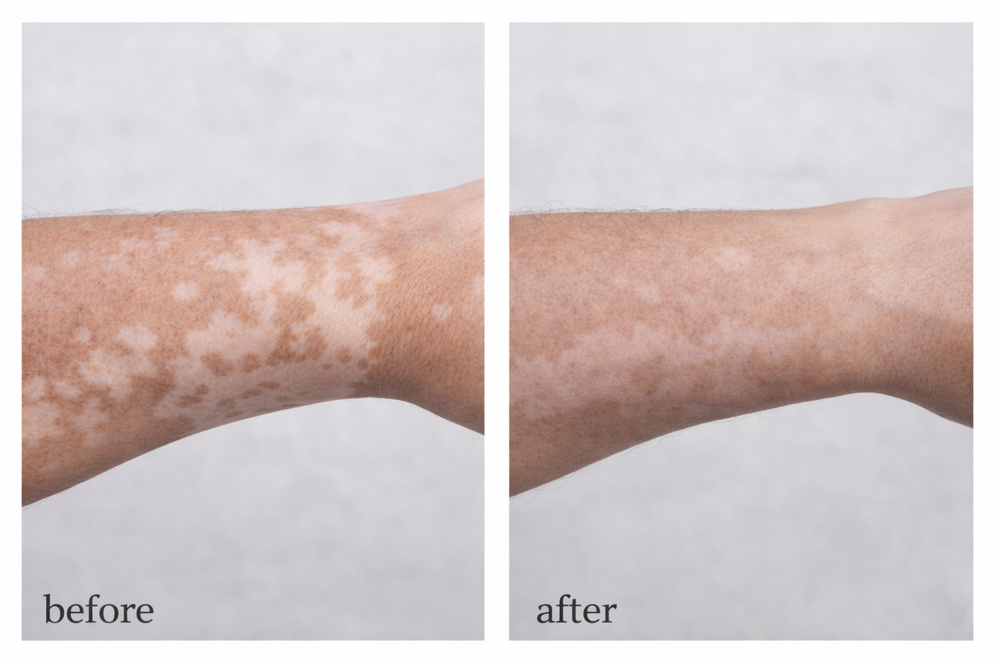 1 x Vitiligo Corrector