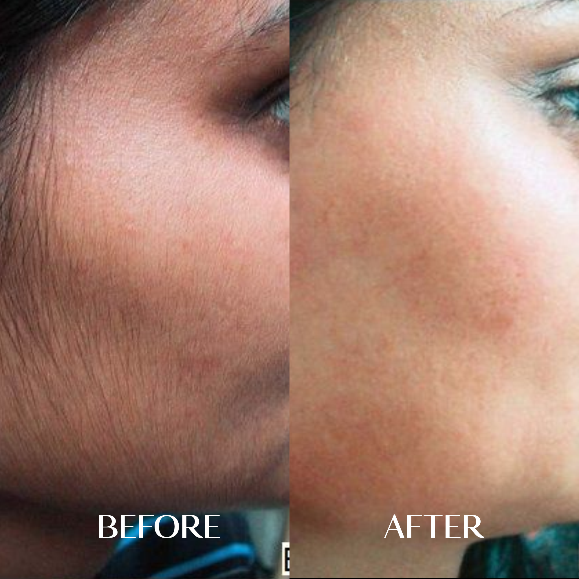 The Facial Hair Serum | 1+1 FREE