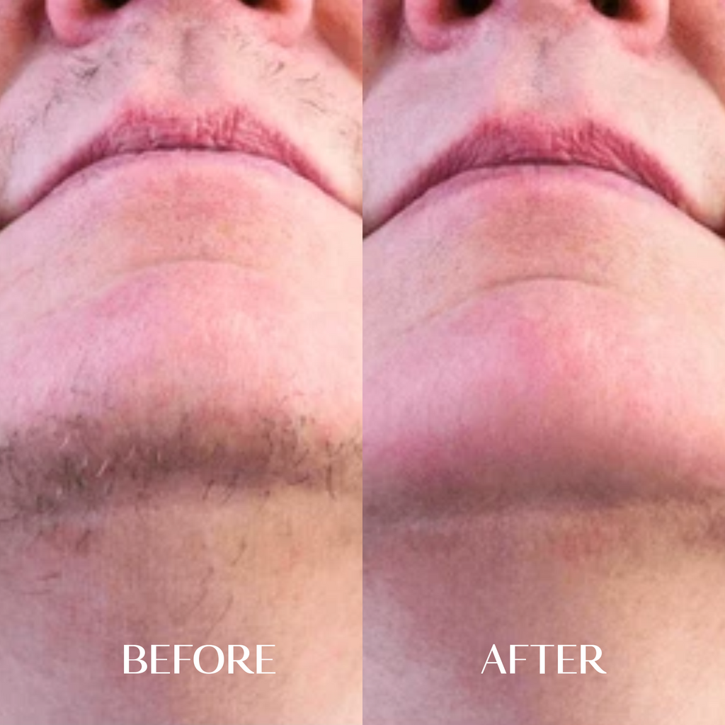 The Facial Hair Serum | 1+1 FREE