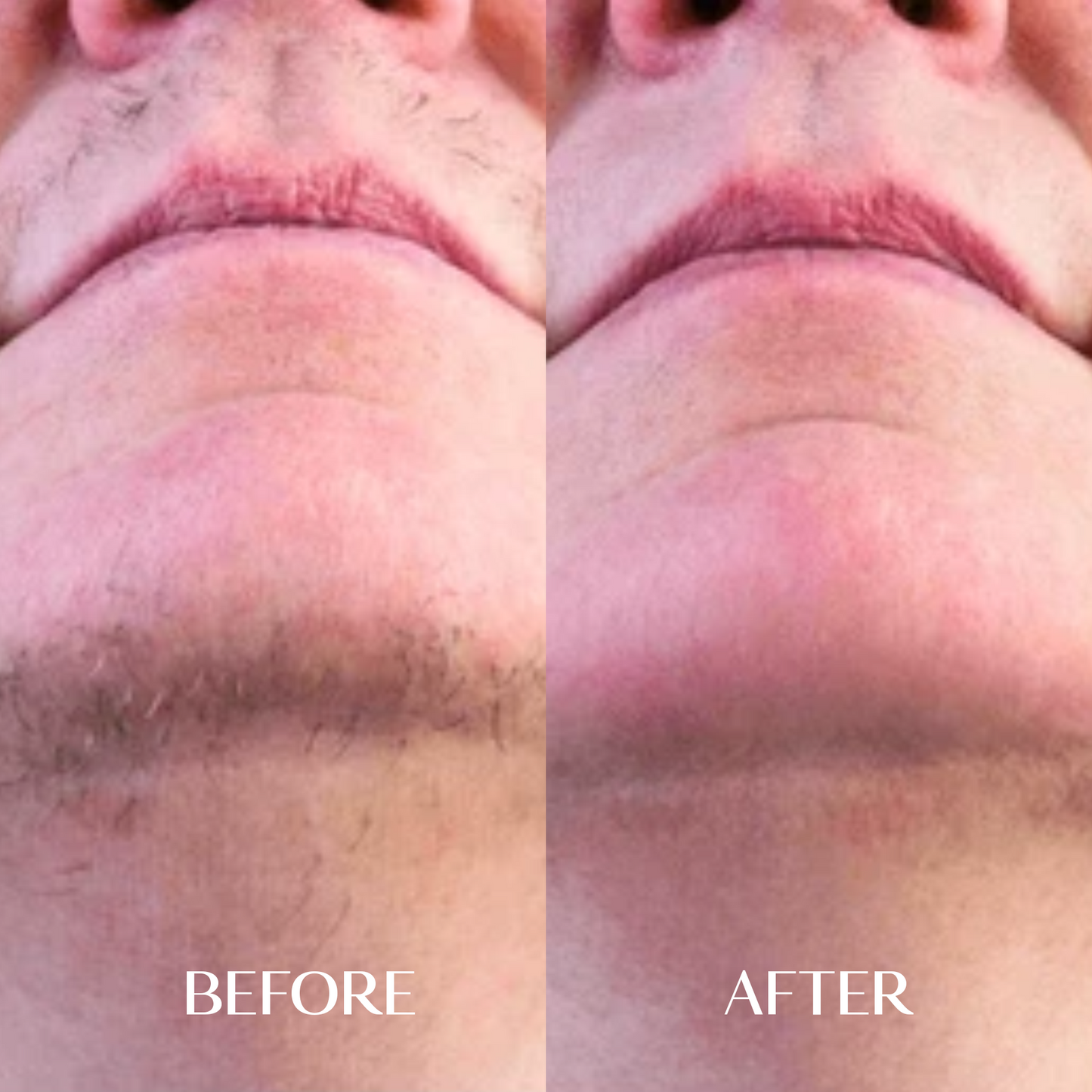 The Facial Hair Serum | 1+1 FREE