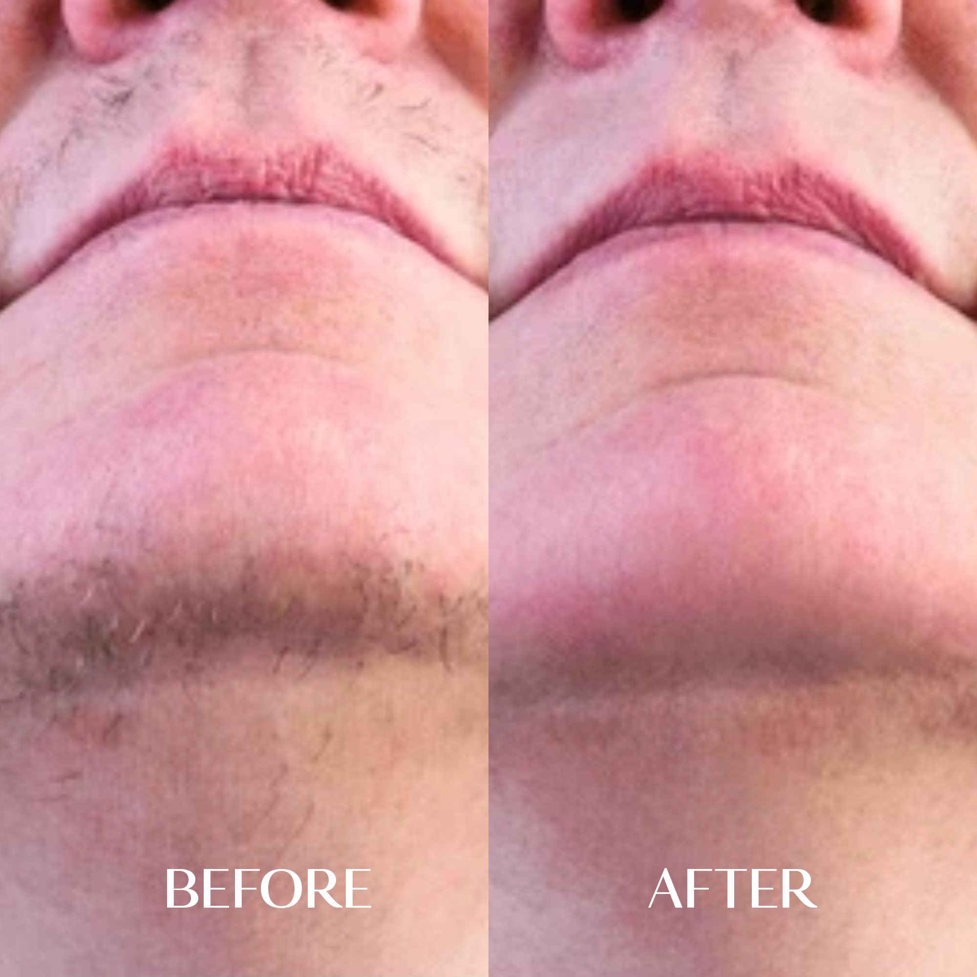 The Facial Hair Serum | 1+1 FREE