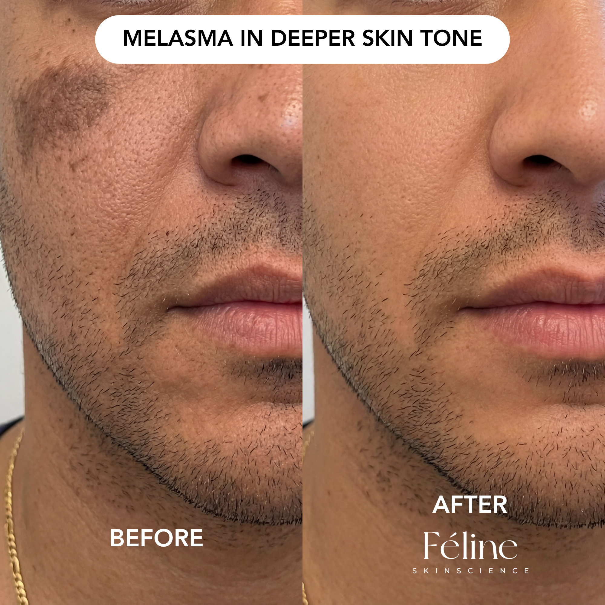 Melasma Corrector (Men’s Formula) | 1+1 FREE