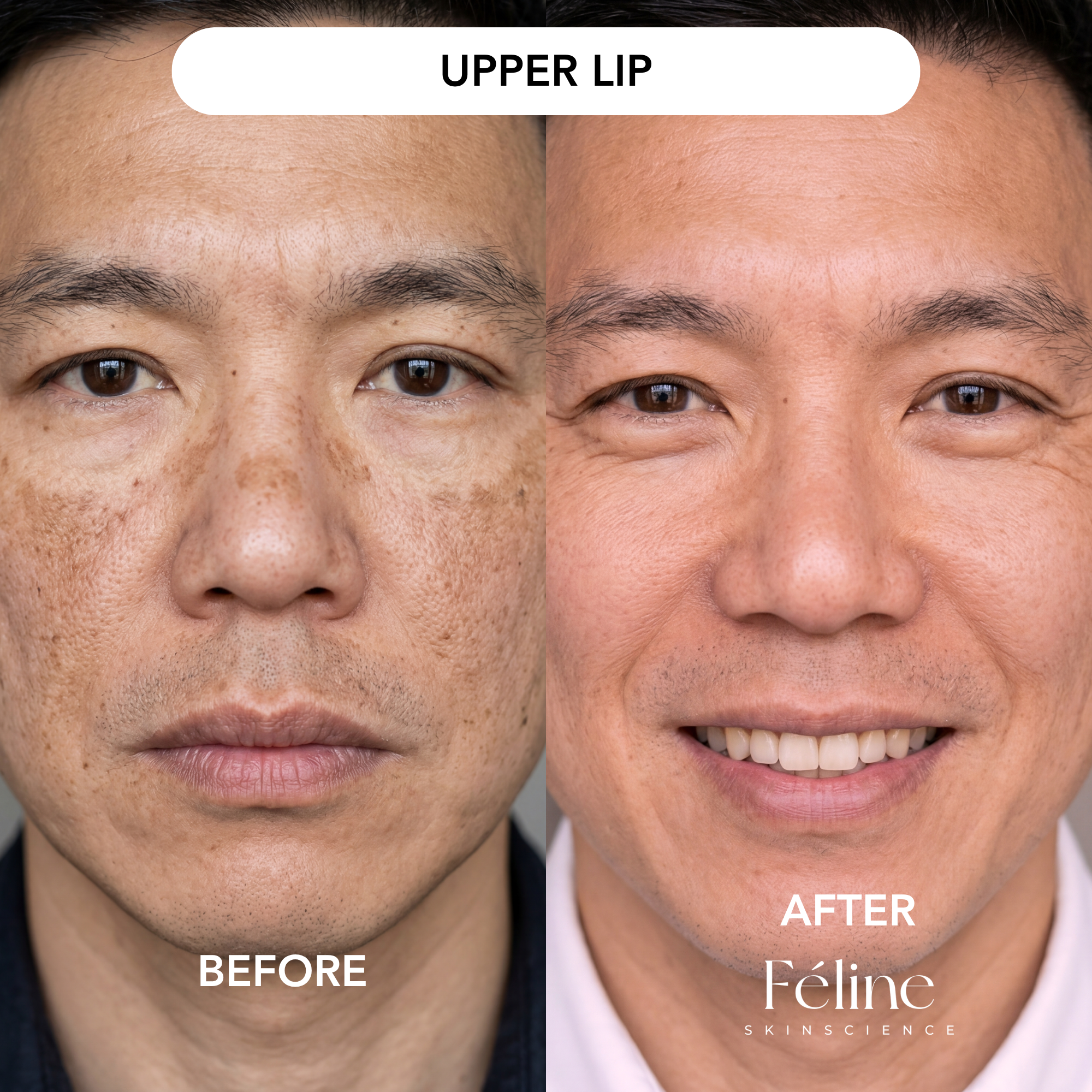 Melasma Corrector (Men’s Formula) | 1+1 FREE