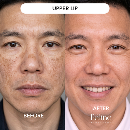 Melasma Corrector (Men’s Formula) | 1+1 FREE