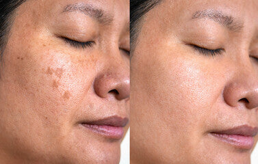 Dark Spot Corrector | 1+1 FREE