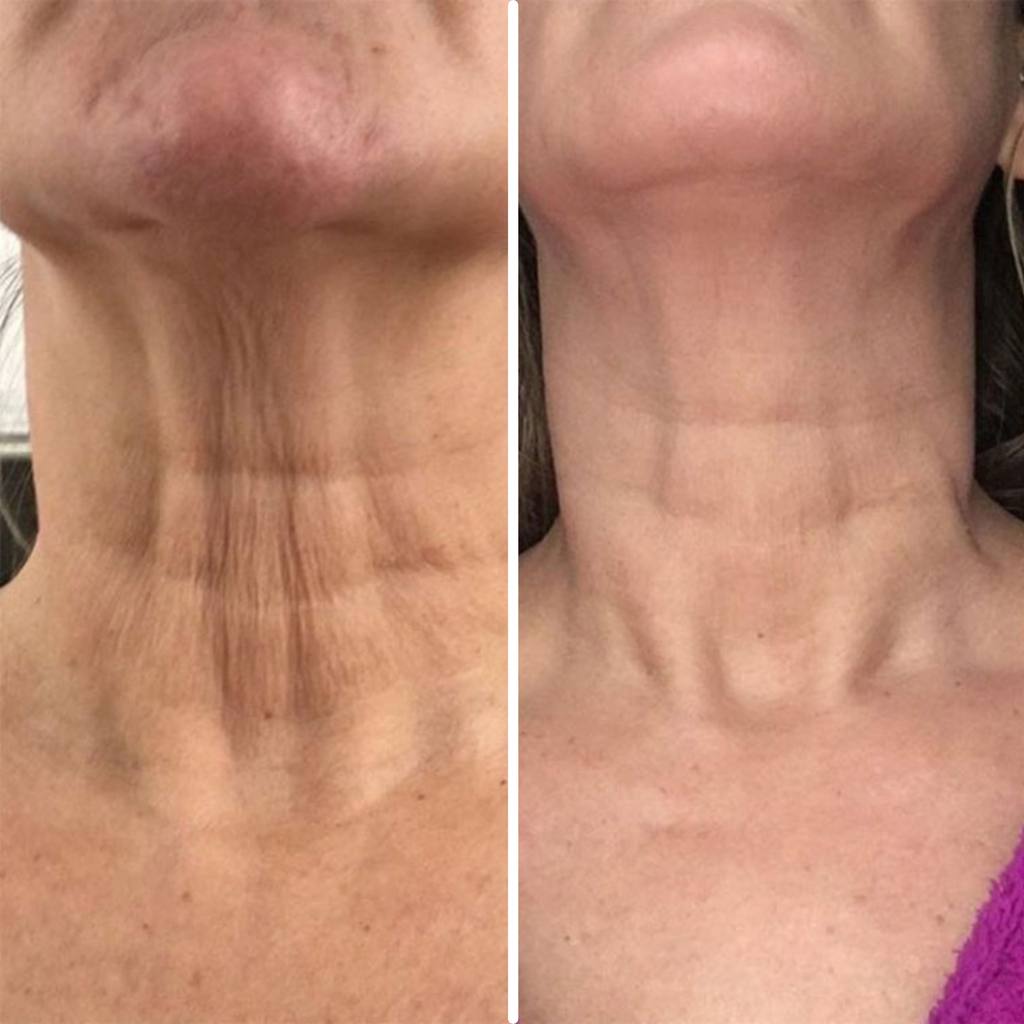 Age-Defying Neck Lift & Firm Cream | 1+1 FREE