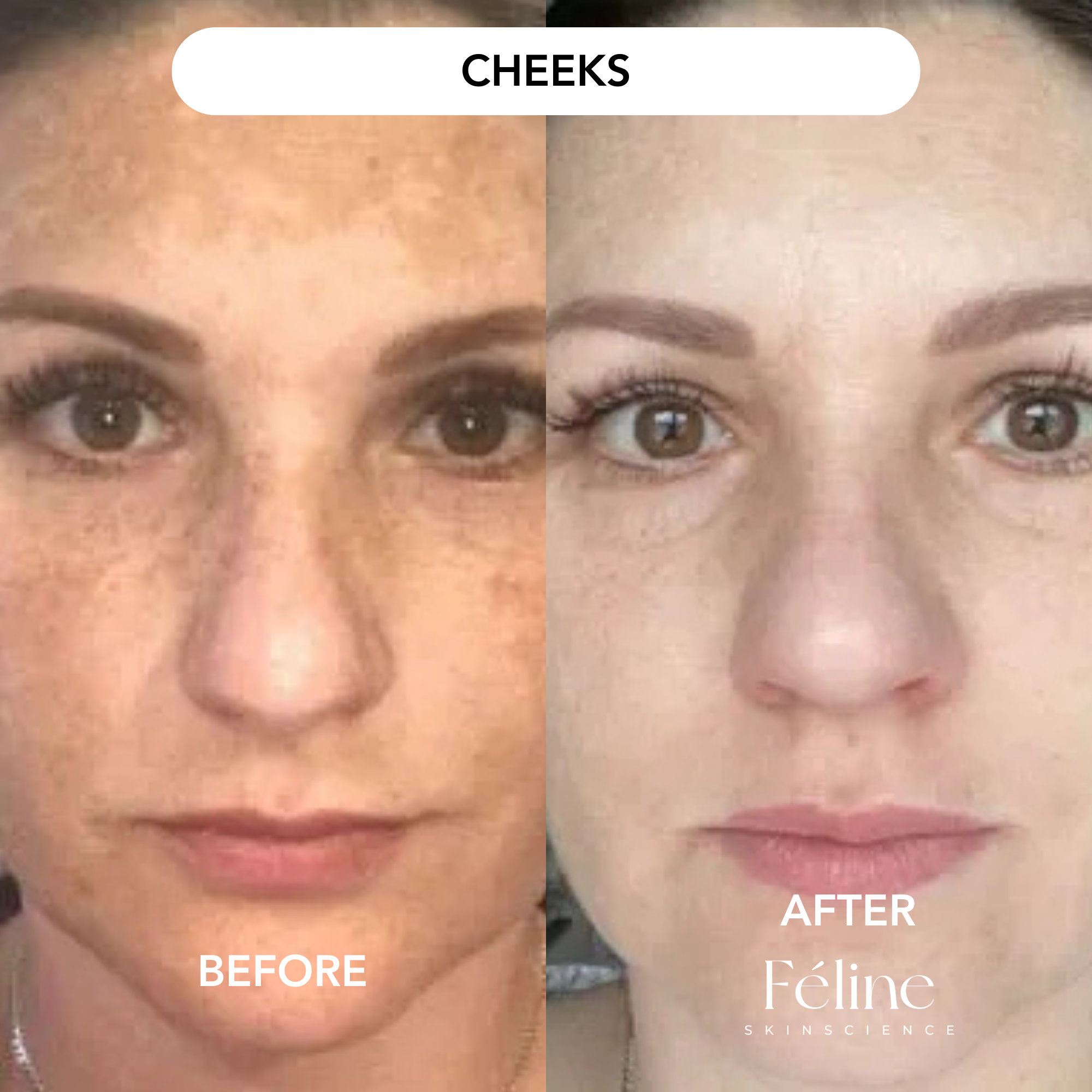 6 x Melasma Corrector