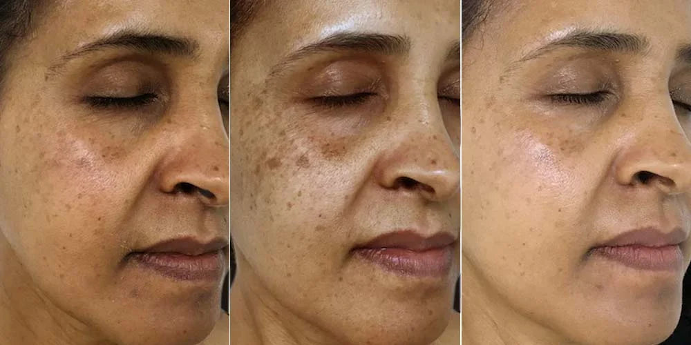 Serum for Hyperpigmentation & Dark Spot Fading | 1+1 FREE