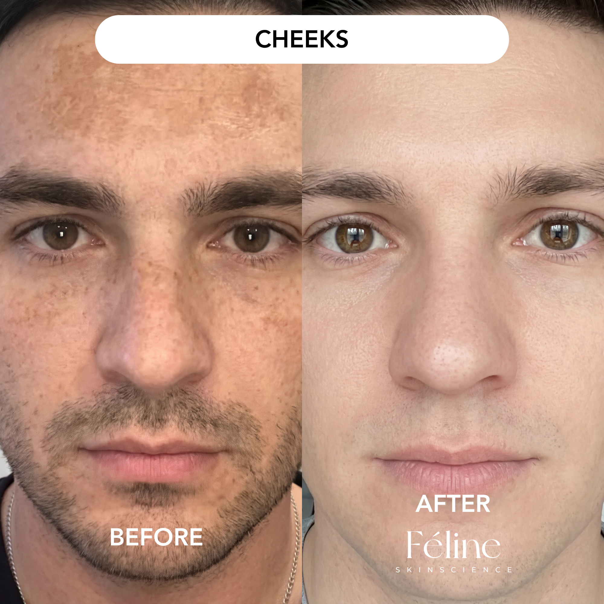Melasma Corrector (Men’s Formula) | 1+1 FREE