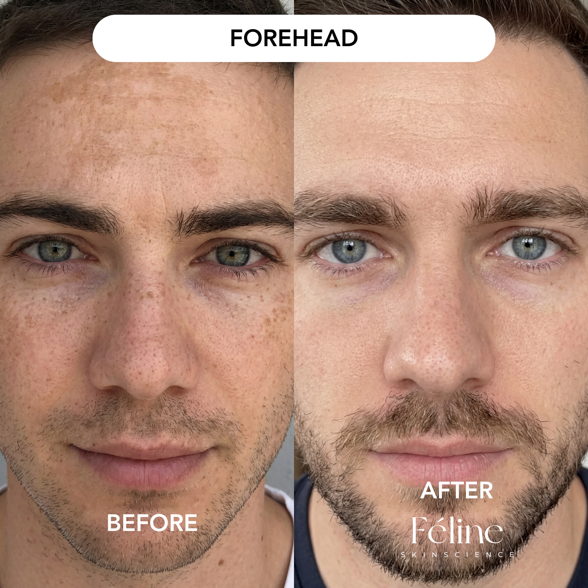 Melasma Corrector (Men’s Formula) | 1+1 FREE