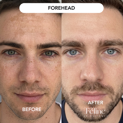 Melasma Corrector (Men’s Formula) | 1+1 FREE