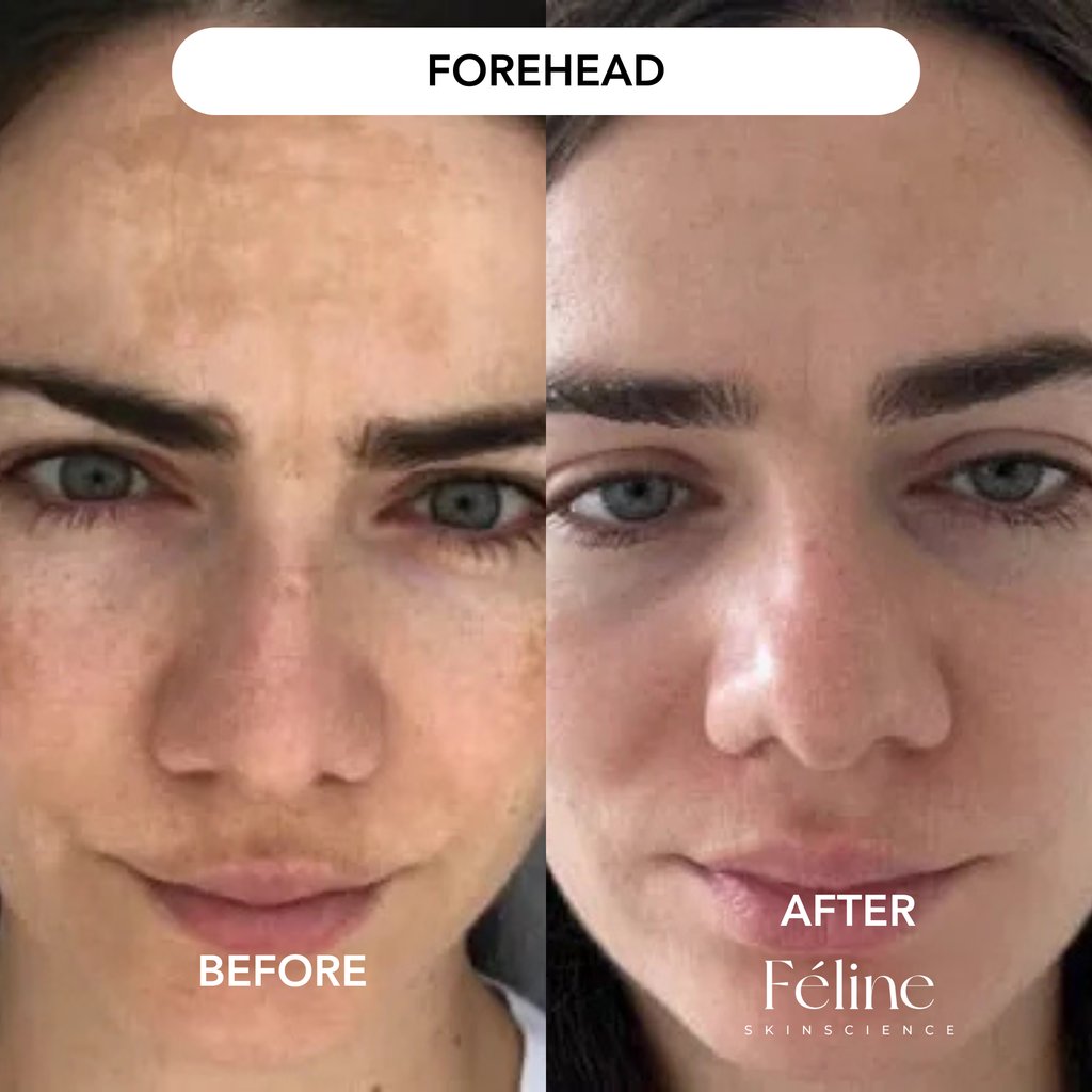 Melasma Corrector