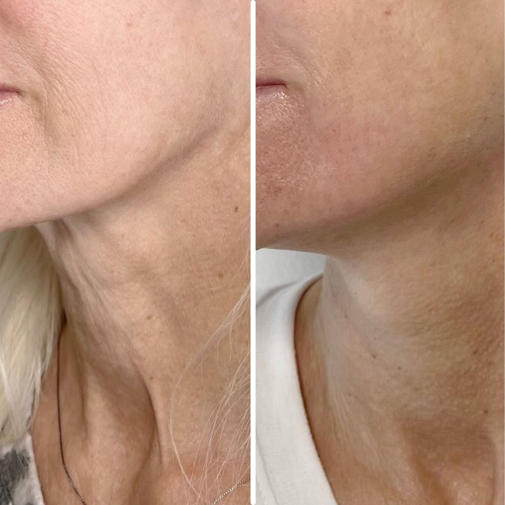 Advanced  Neck Crepe Fix | 1+1 FREE