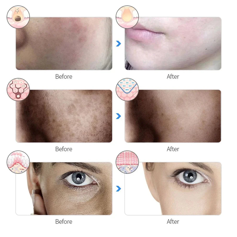 LED Face Mask for Anti Aging, Acne & Skin Rejuvenation