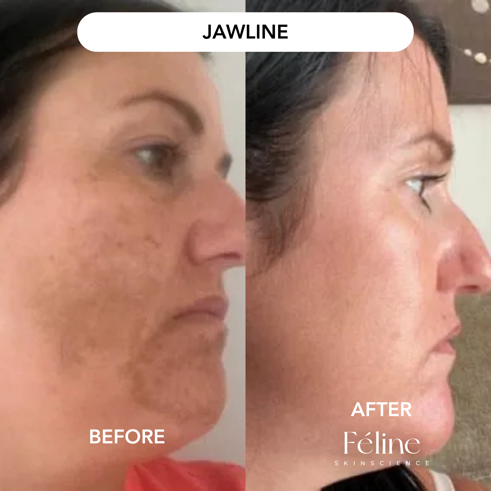 Melasma Corrector