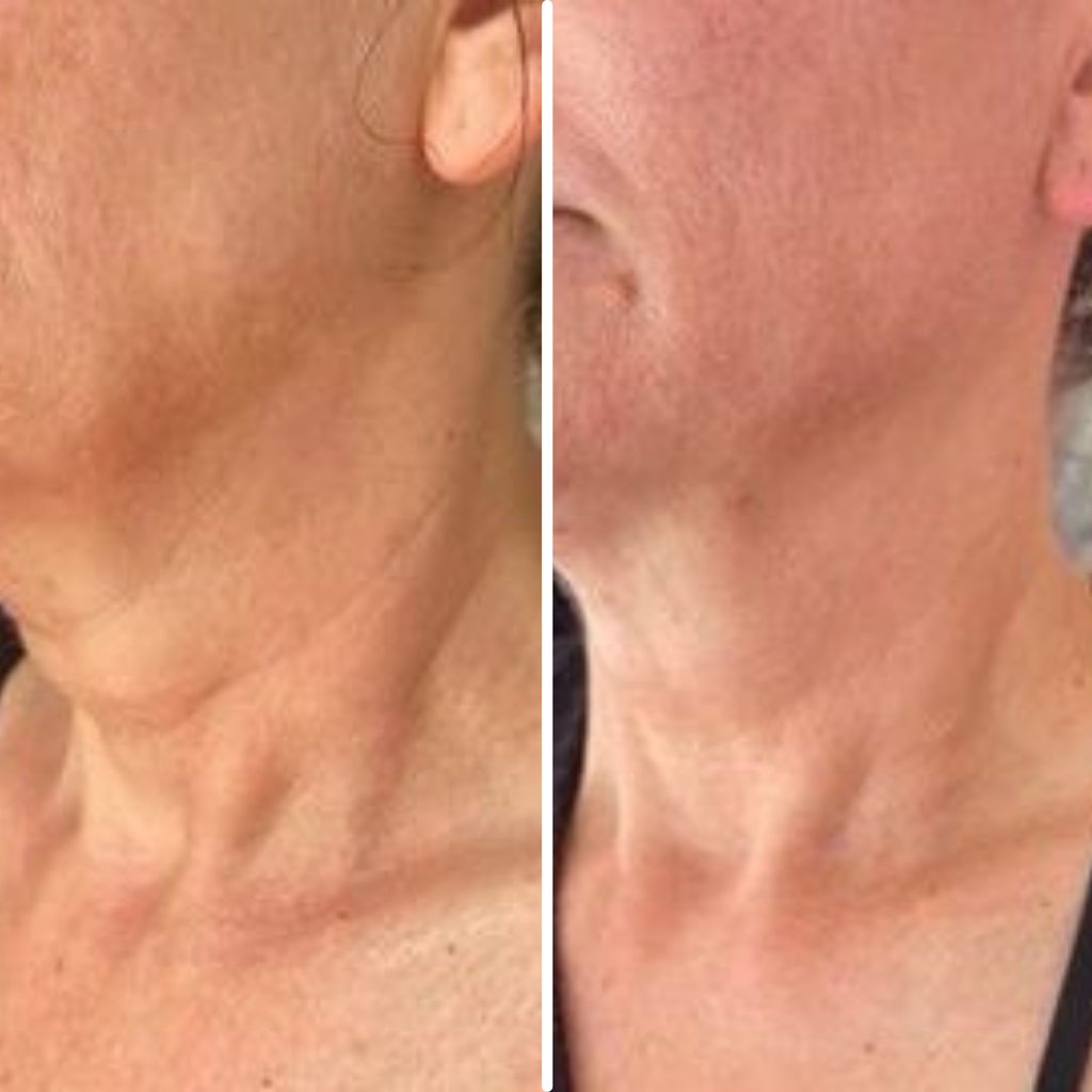 Advanced  Neck Crepe Fix | 1+1 FREE