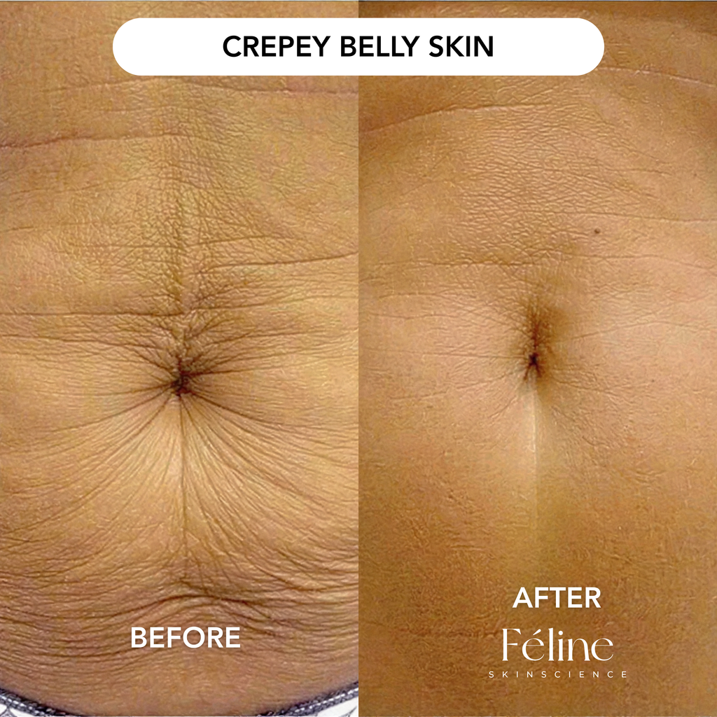 CrepeFree Arm™ | 1+1 FREE