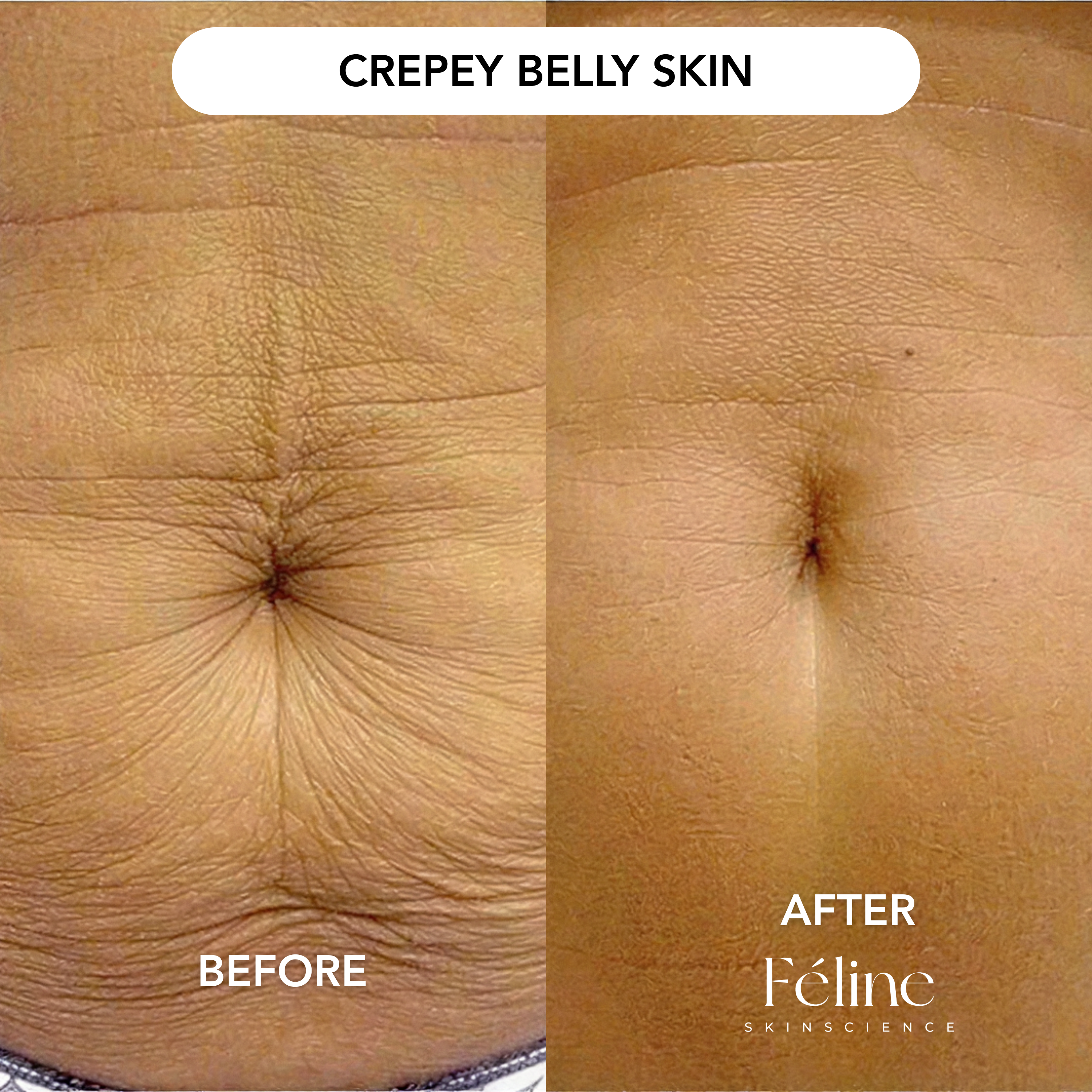 CrepeFree Arm™ | 1+1 FREE