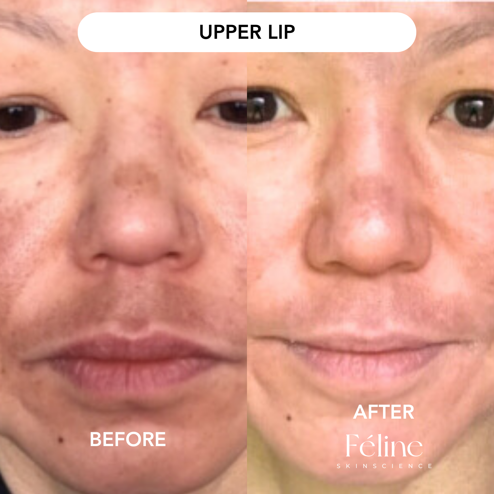 Melasma Corrector