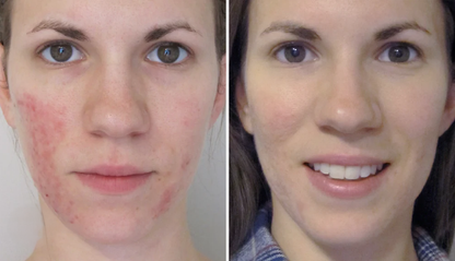 Rosacea Corrector