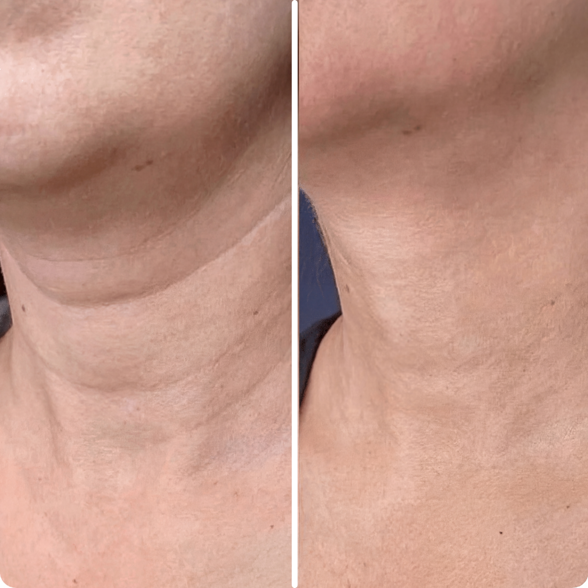 Advanced  Neck Crepe Fix | 1+1 FREE