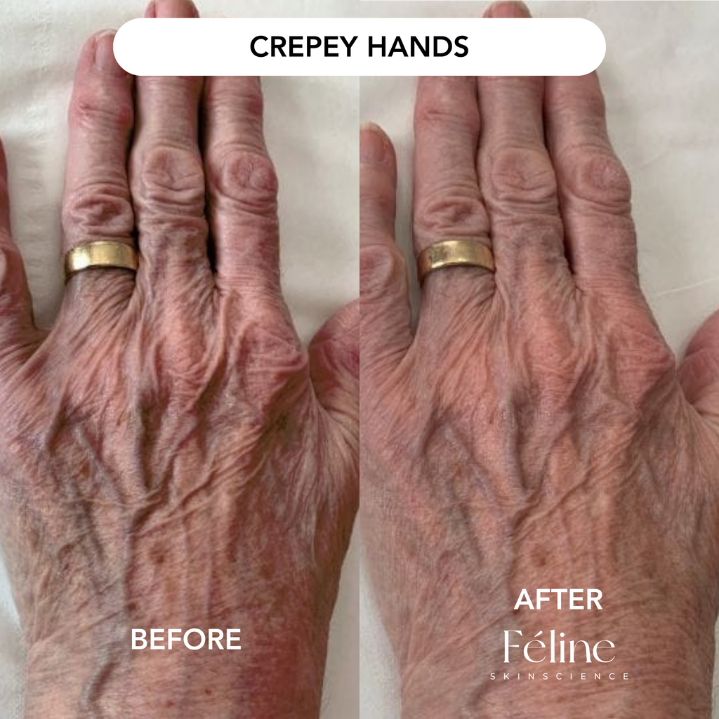 CrepeFree Belly™ | 1+1 FREE