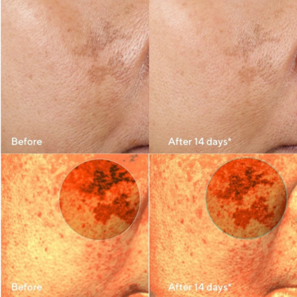 The Complete Dark Spot Solution | Erase & Block