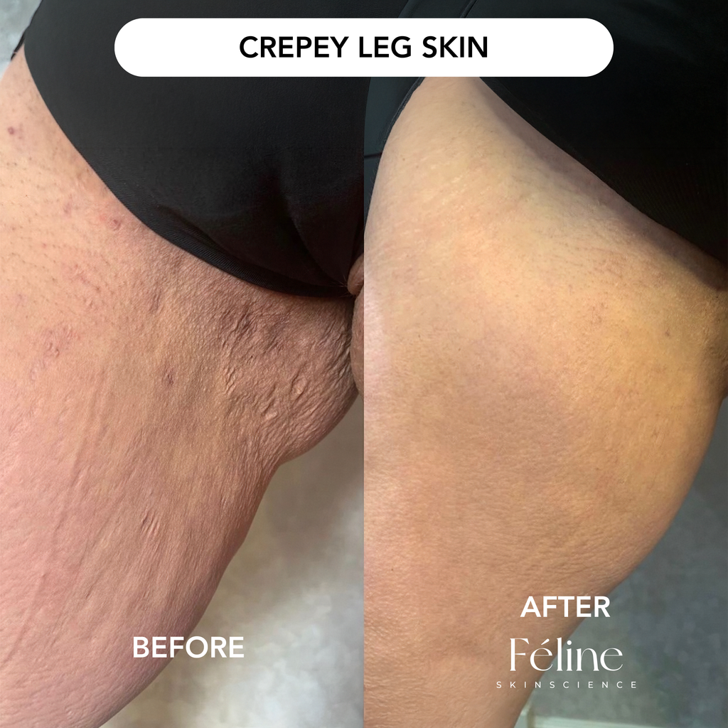 CrepeFree Belly™ | 1+1 FREE