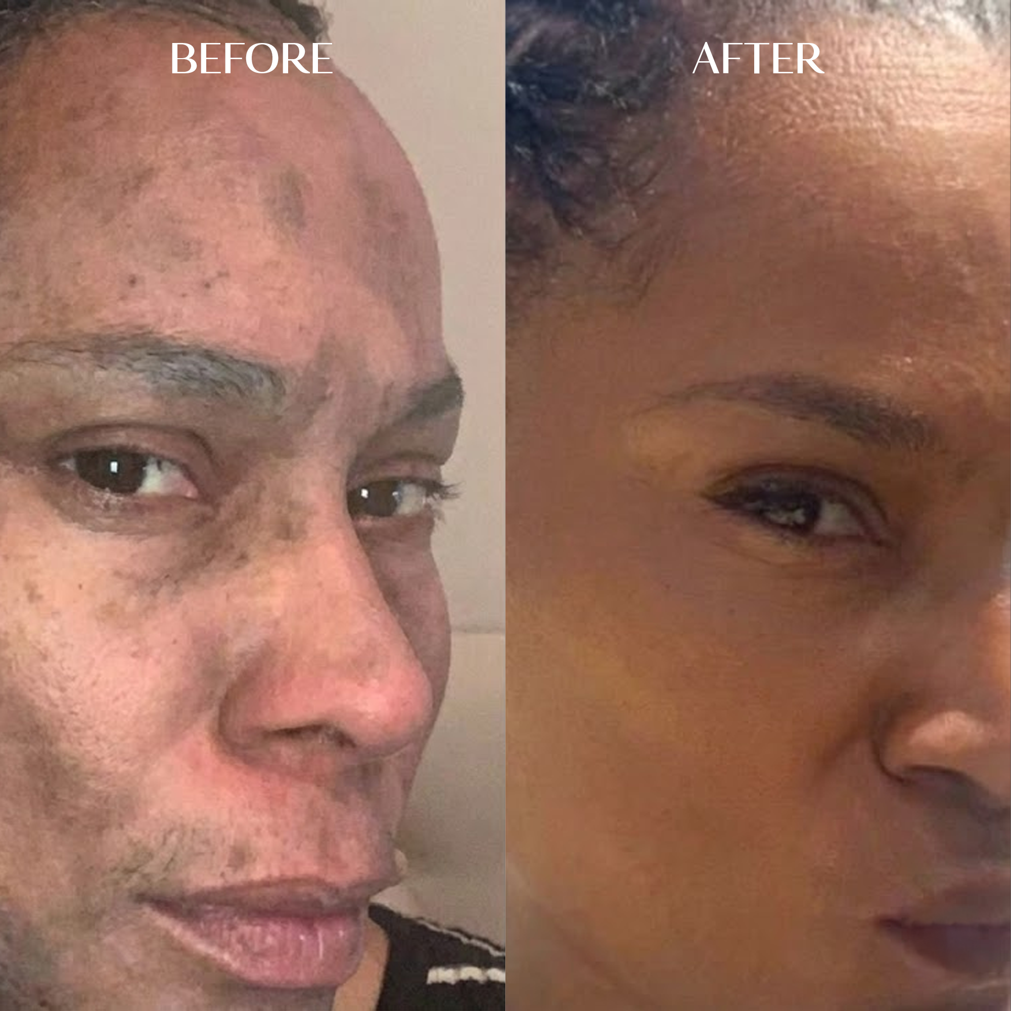 Melanin Dark Spot Corrector | 1+1 FREE