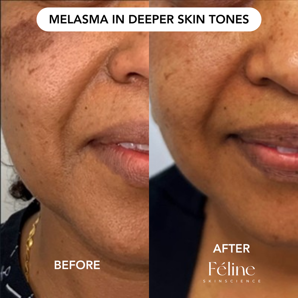 Melasma Corrector