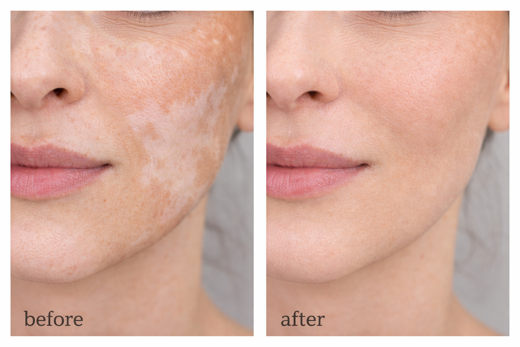 Vitiligo Corrector