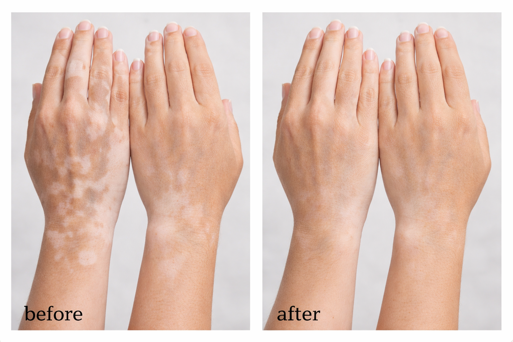 Vitiligo Corrector