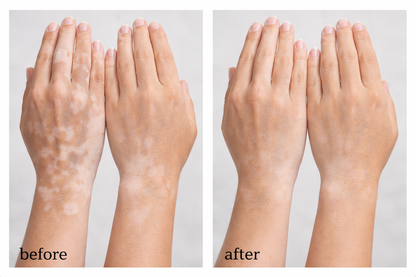 Vitiligo Corrector
