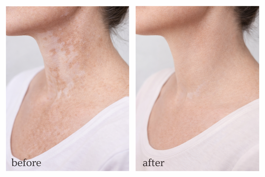 Vitiligo Corrector
