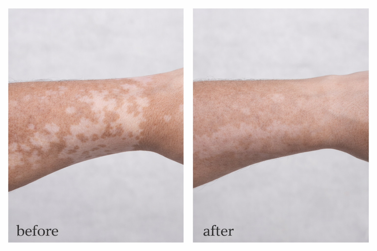 Vitiligo Corrector