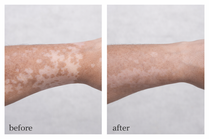 Vitiligo Corrector