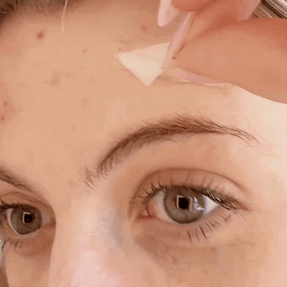 Hydrocolloid Acne Patches Roll for Pimples & Breakouts