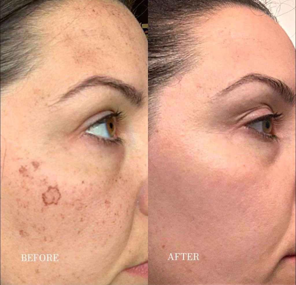 Dark Spot Corrector for Sun Spots & Age Spots | 1+1 FREE