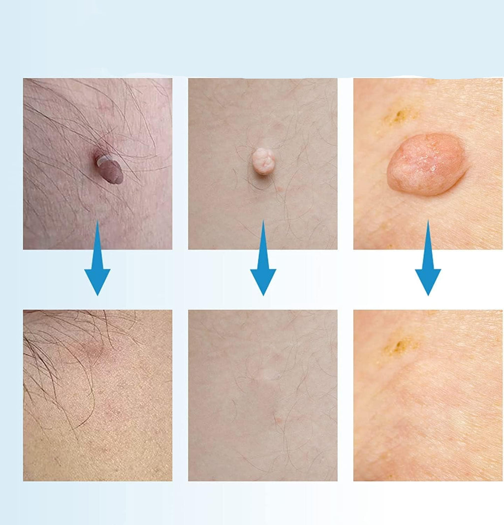 Skin Tag & Mole Remover Pen for Safe Removal at Home