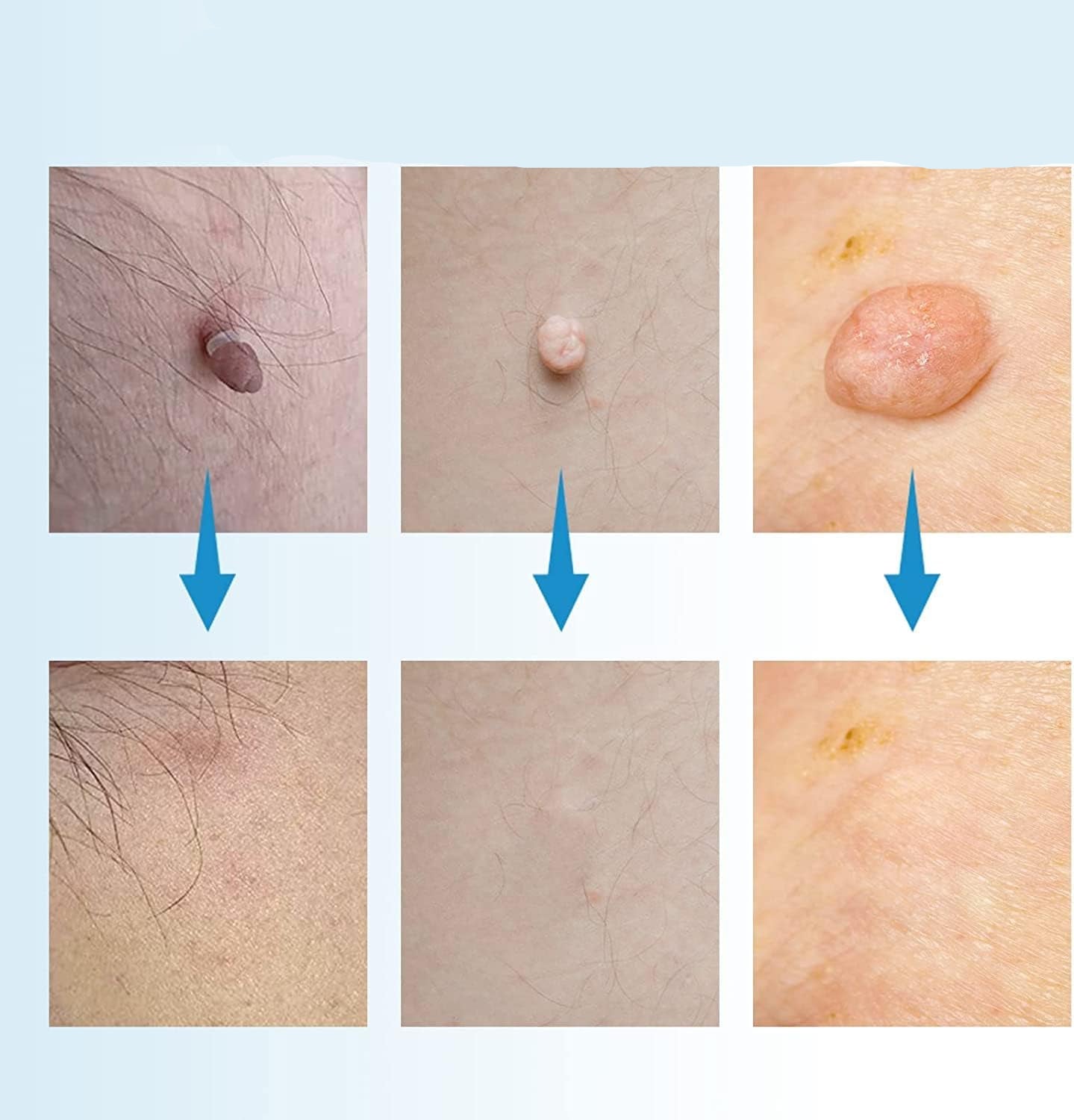 Skin Tag & Mole Remover Pen for Safe Removal at Home