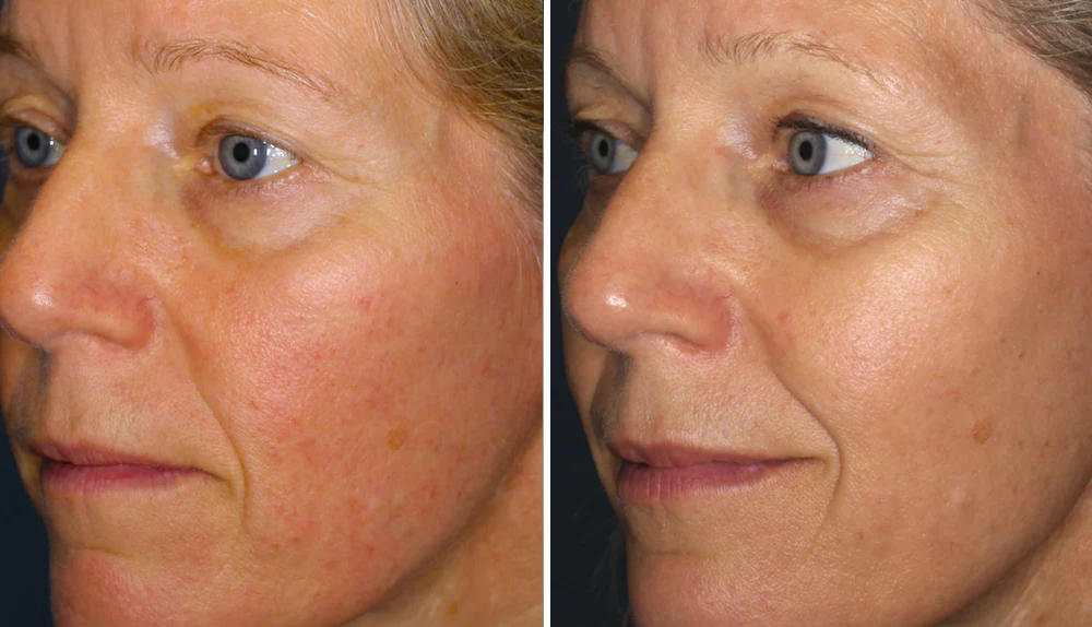 Face Serum for Persistent Redness, Flushing & Sensitive Skin | 1+1 FREE