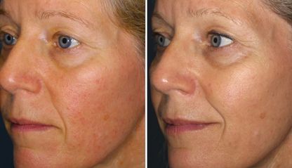 Face Serum for Persistent Redness, Flushing & Sensitive Skin | 1+1 FREE
