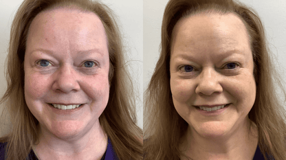 Rosacea Corrector