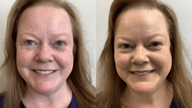 6 x Rosacea Corrector