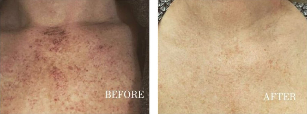 Dark Spot Corrector Serum for Fast Spot Fading & Clear Skin | 1+1 FREE