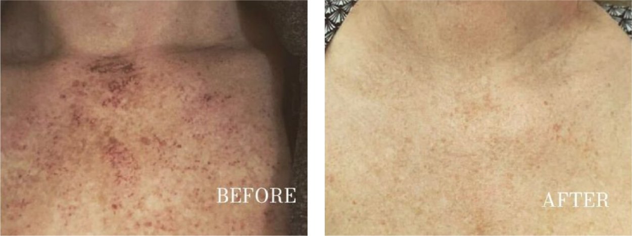 Dark Spot Corrector for Sun Spots & Age Spots | 1+1 FREE