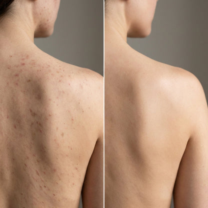 Post Acne Mark Corrector | 1+1 FREE