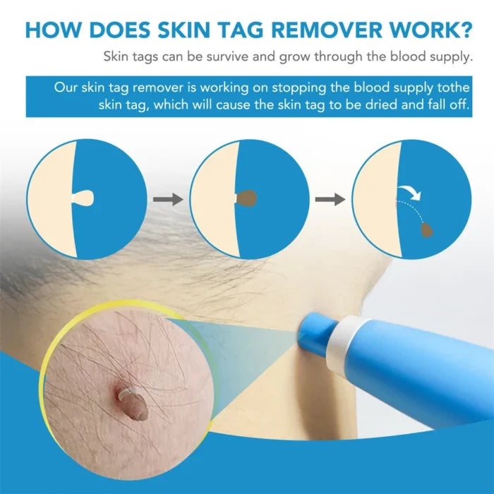 Skin Tag & Mole Remover Pen for Safe Removal at Home