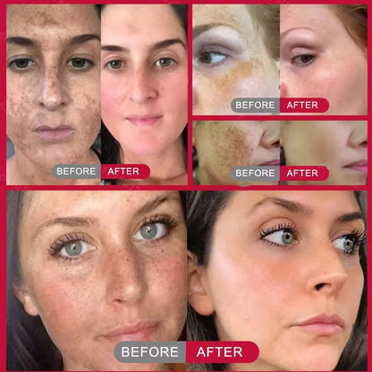 Whitening Freckles Face Cream