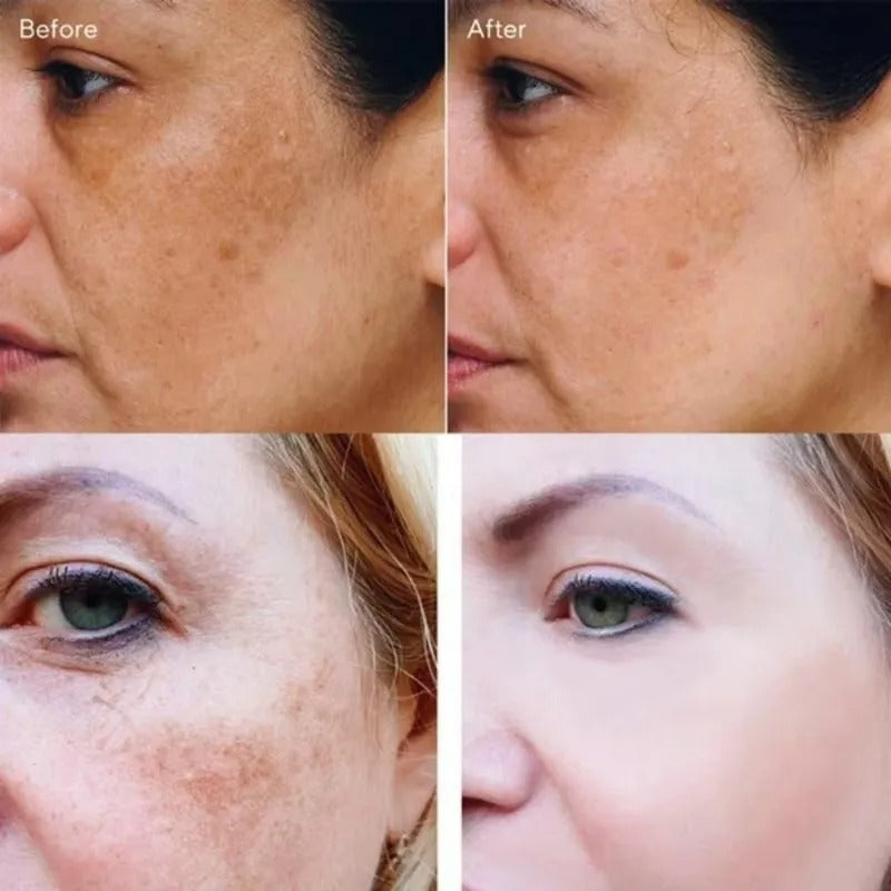 Dark Spot Corrector Serum for Hyperpigmentation & Melasma